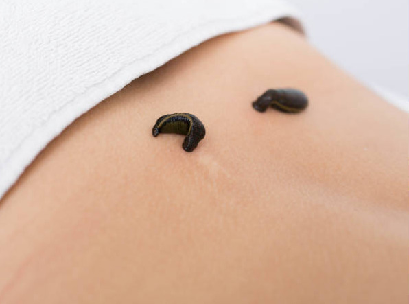 Hirudoterapie — lipitori pe abdomen